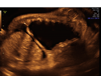 Hydrops pleural effusions and ascites view